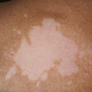 vitiligo